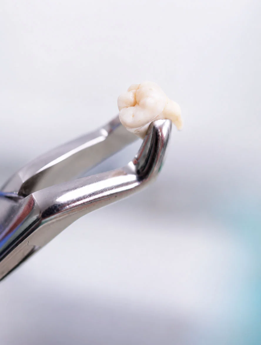Close-up of an extracted tooth held with dental forceps during an oral surgery procedure.