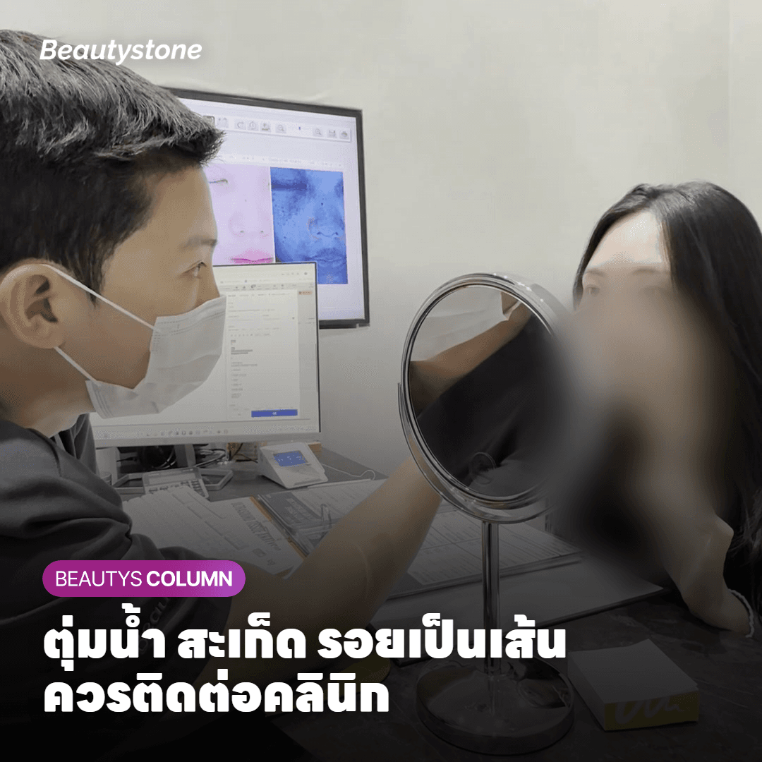 ผิวคนเอเชียต้องระวังรอยดำที่ตามมาทีหลัง