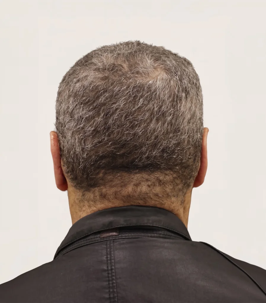 Harmoniously positioned ears seen from behind after otoplasty in Turkey