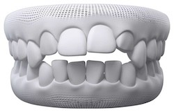 Open bite teeth