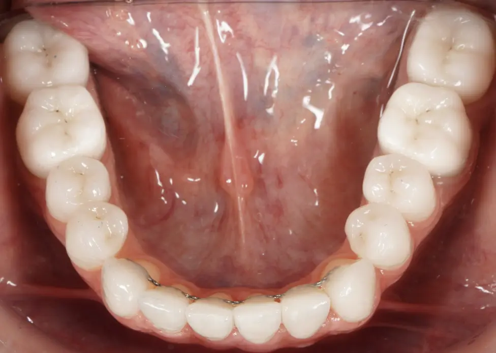 After prosthetic rehabilitation