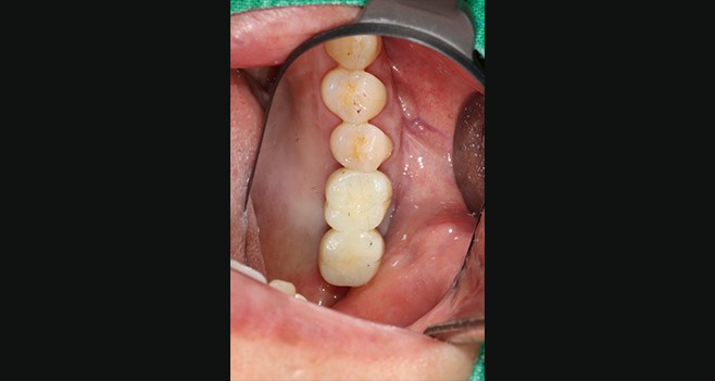 26,27 보철셋팅