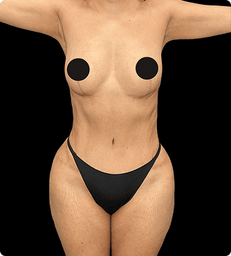 Resultado de antes y después de liposucción en Mendoza Plastic Surgery en Atlanta