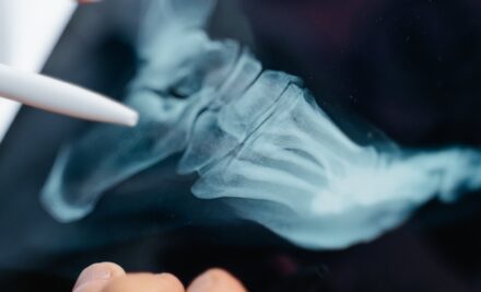 Mágnesterápia fáradásos törések és csontszerkezeti eltérések esetén