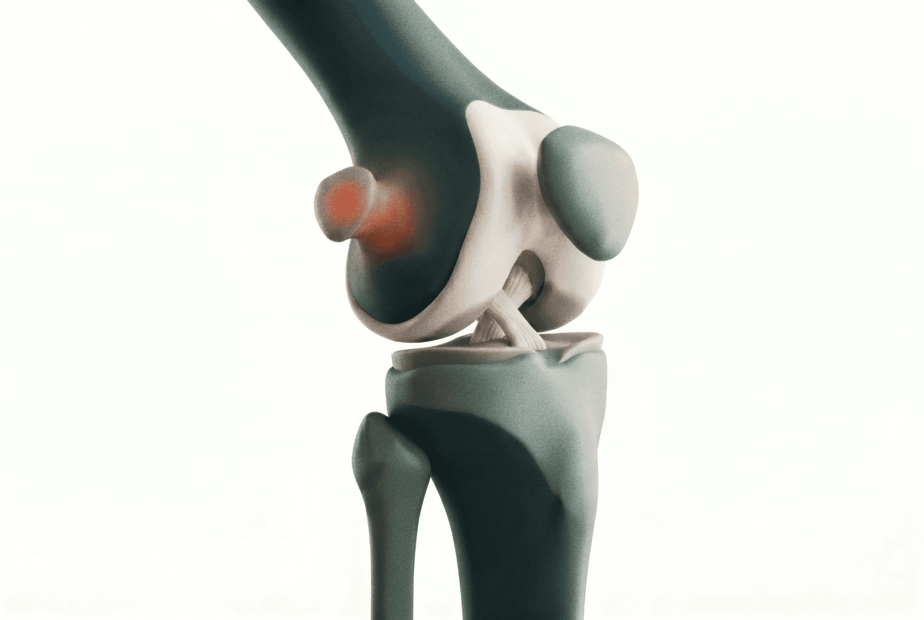 Child Osteochrondroma
