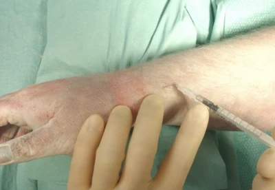 De Quervain's corticosteroid injection