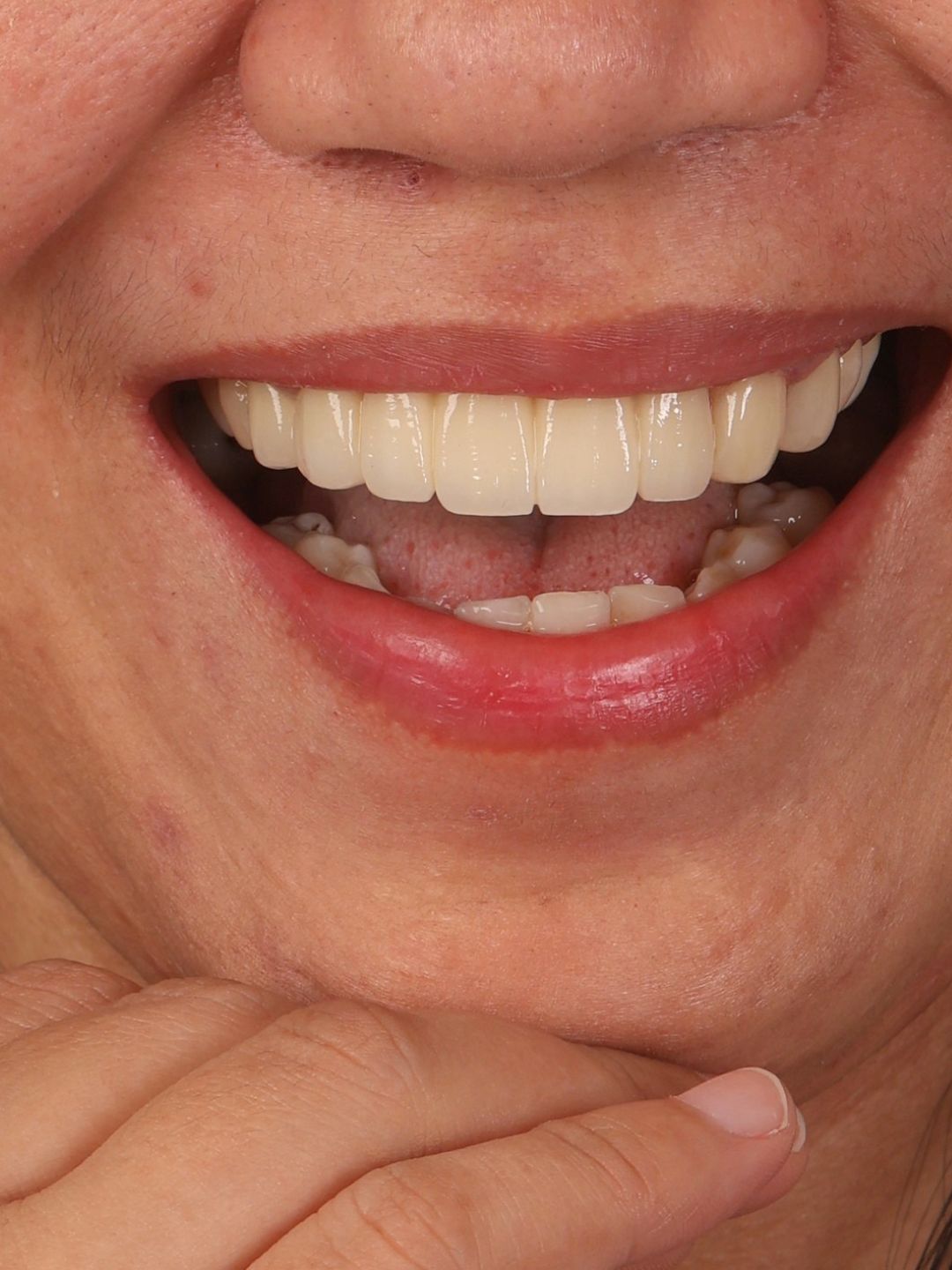Patient smiling naturally after zirconia bridge restoration at Ora Dental Makati