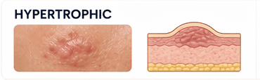 Hypertrophic Scar