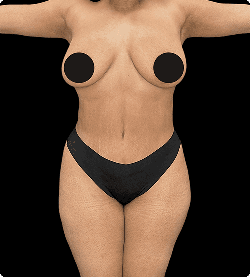 LIPOABDOMINOPLASTIA + TUMMY TUCK - AFTER