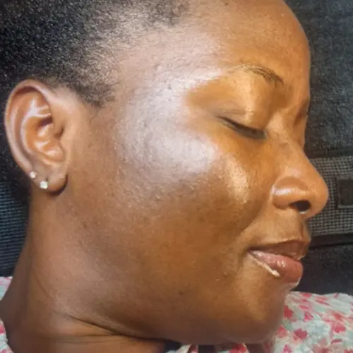 After pigmentation discolouration treatment at The Vancouver Aesthetician — hyperpigmentation and PIH visibly faded, skin tone corrected and complexion noticeably more even