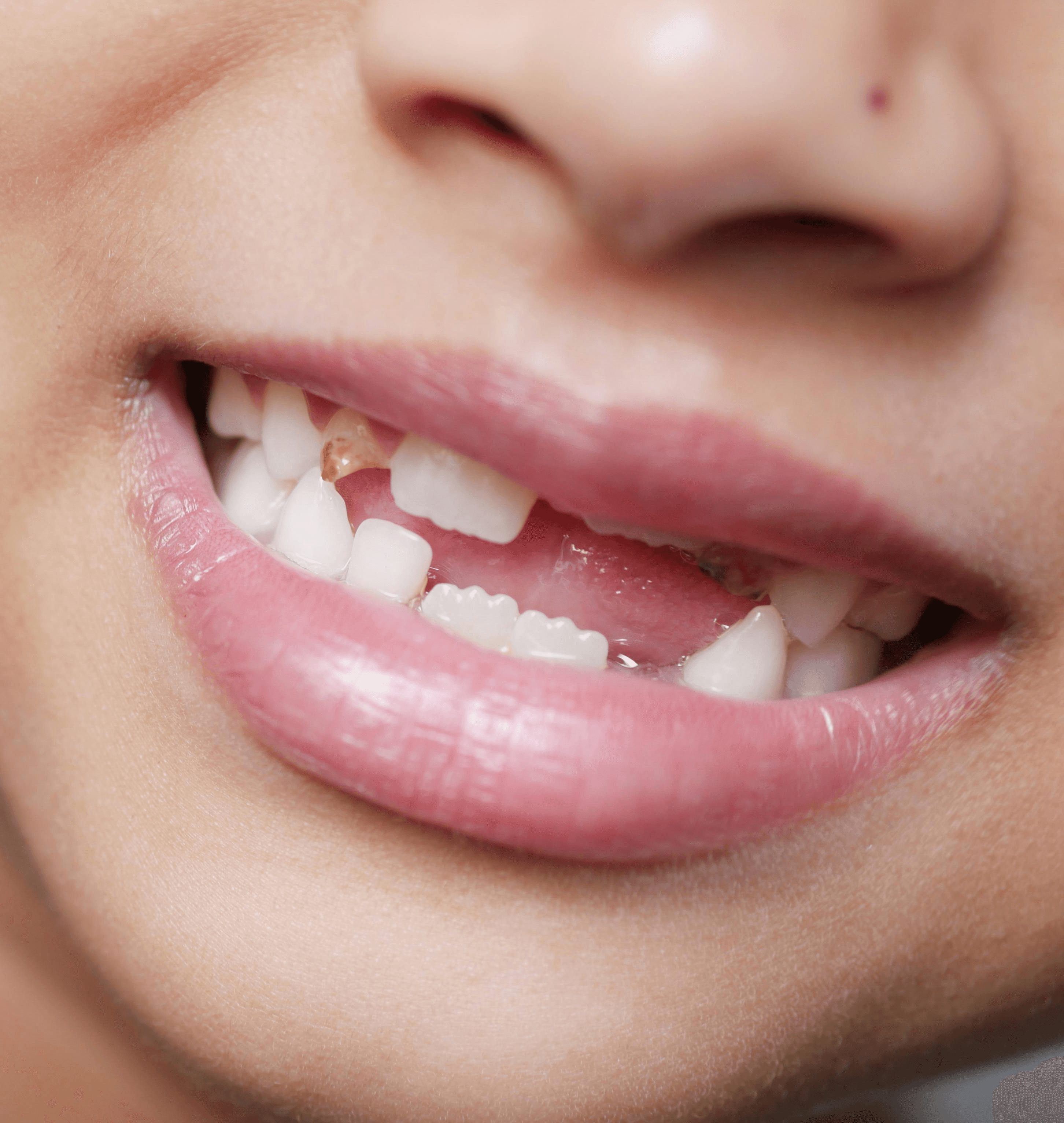 detailed-image-showing-a-child's-mouth-with-missing-teeth,-capturing-a-youthful- - towfiqu-barbhuiya (pexels)