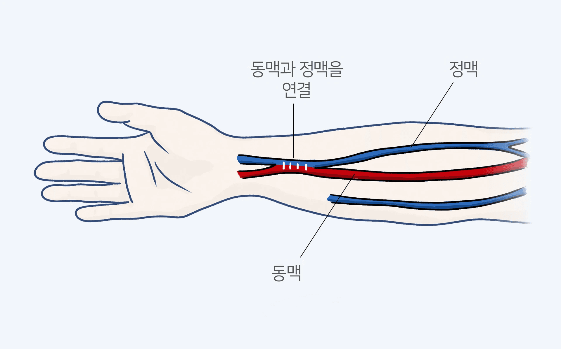 동정맥루 조성술 일러스트