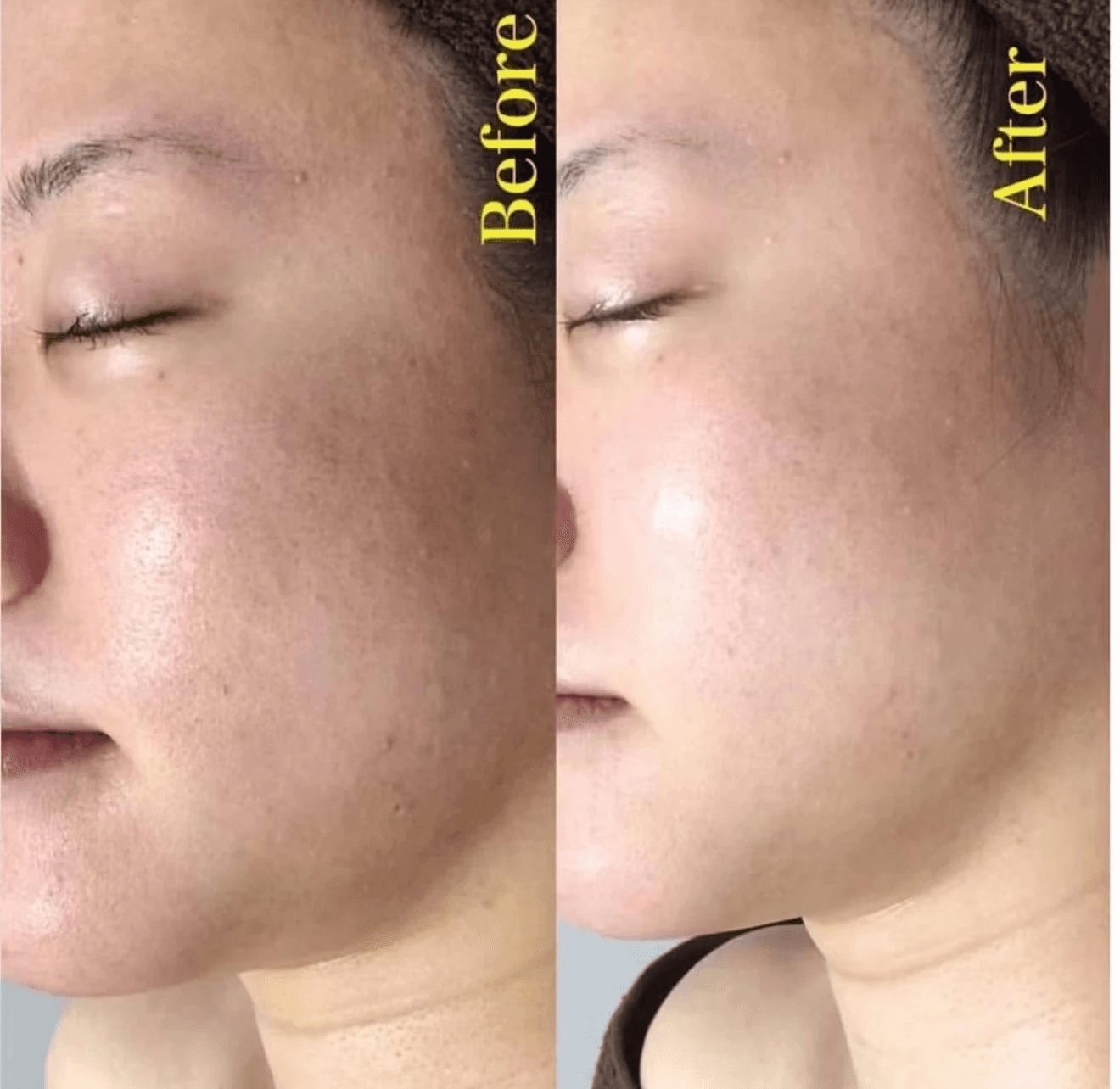 Toro Detox Carbon laser peel treatment before and after results on a woman's face.