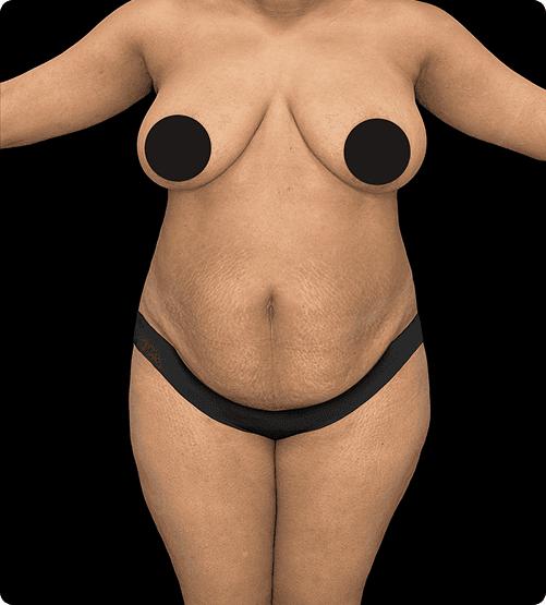 LIPOABDOMINOPLASTIA + TUMMY TUCK - BEFORE