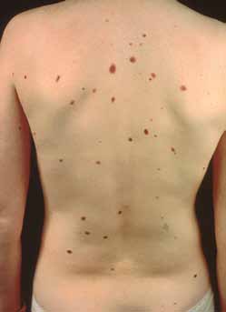 Figure 5: Benign melanocytic naevus