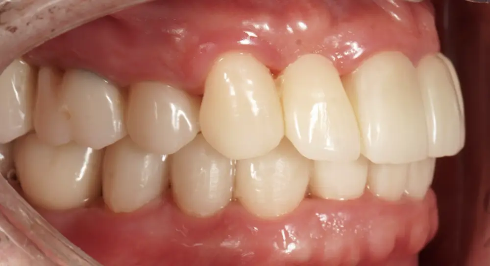 After ortho treatment