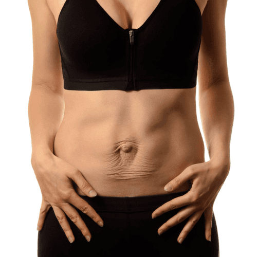 Ventre de femme après une grossesse ayant un diastasis des grands droits