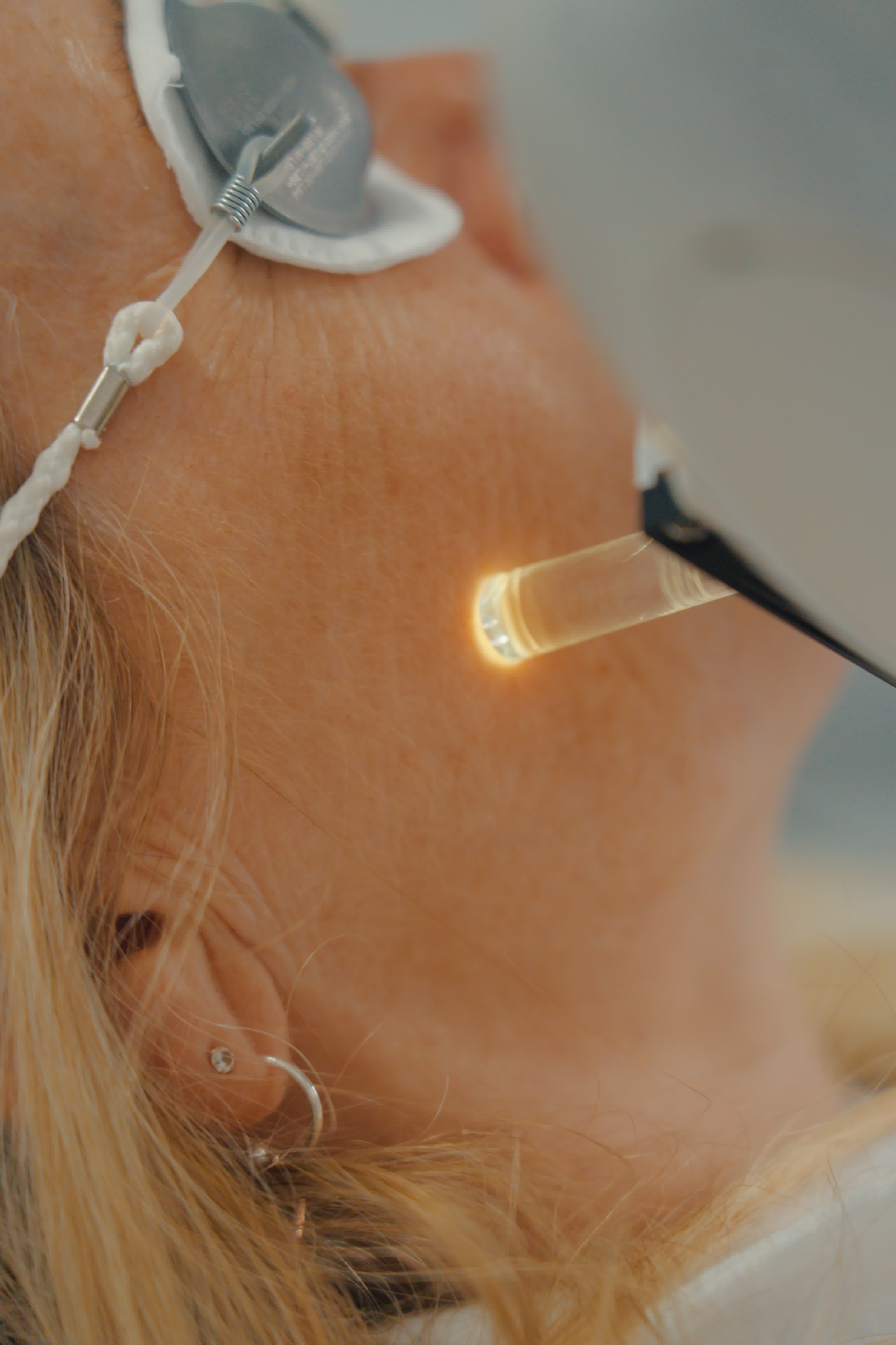 Laser treatment on face.