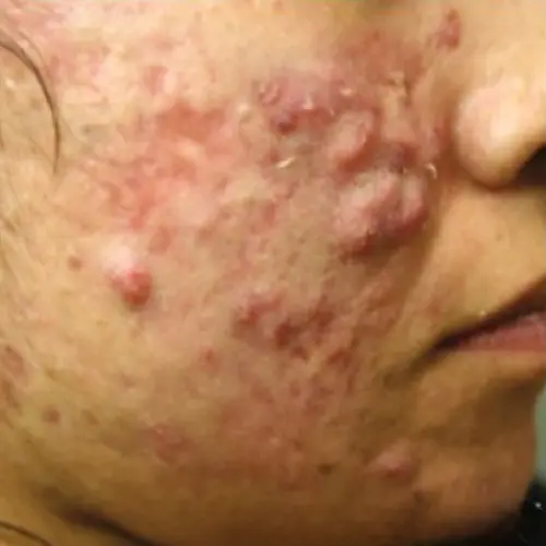 Before laser treatment for cystic hormonal acne at The Vancouver Aesthetician — active breakouts and inflammation visible on skin