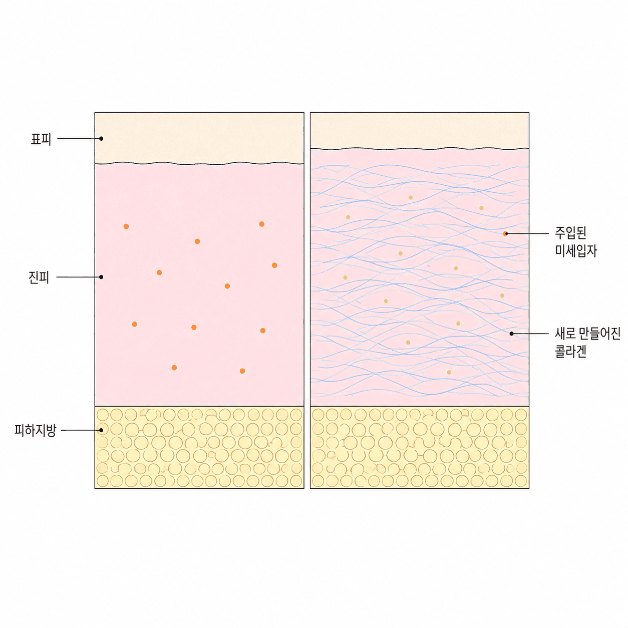 입자는 줄어들고, 그 자리를 새 콜라겐이 대신 채워요.