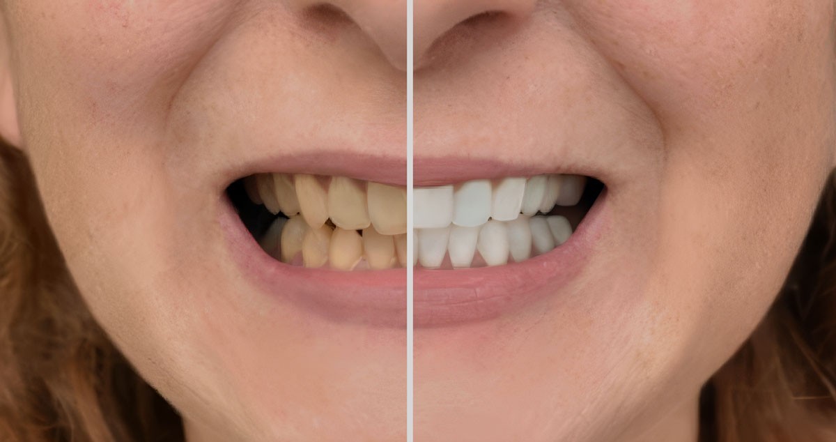 smile makeover