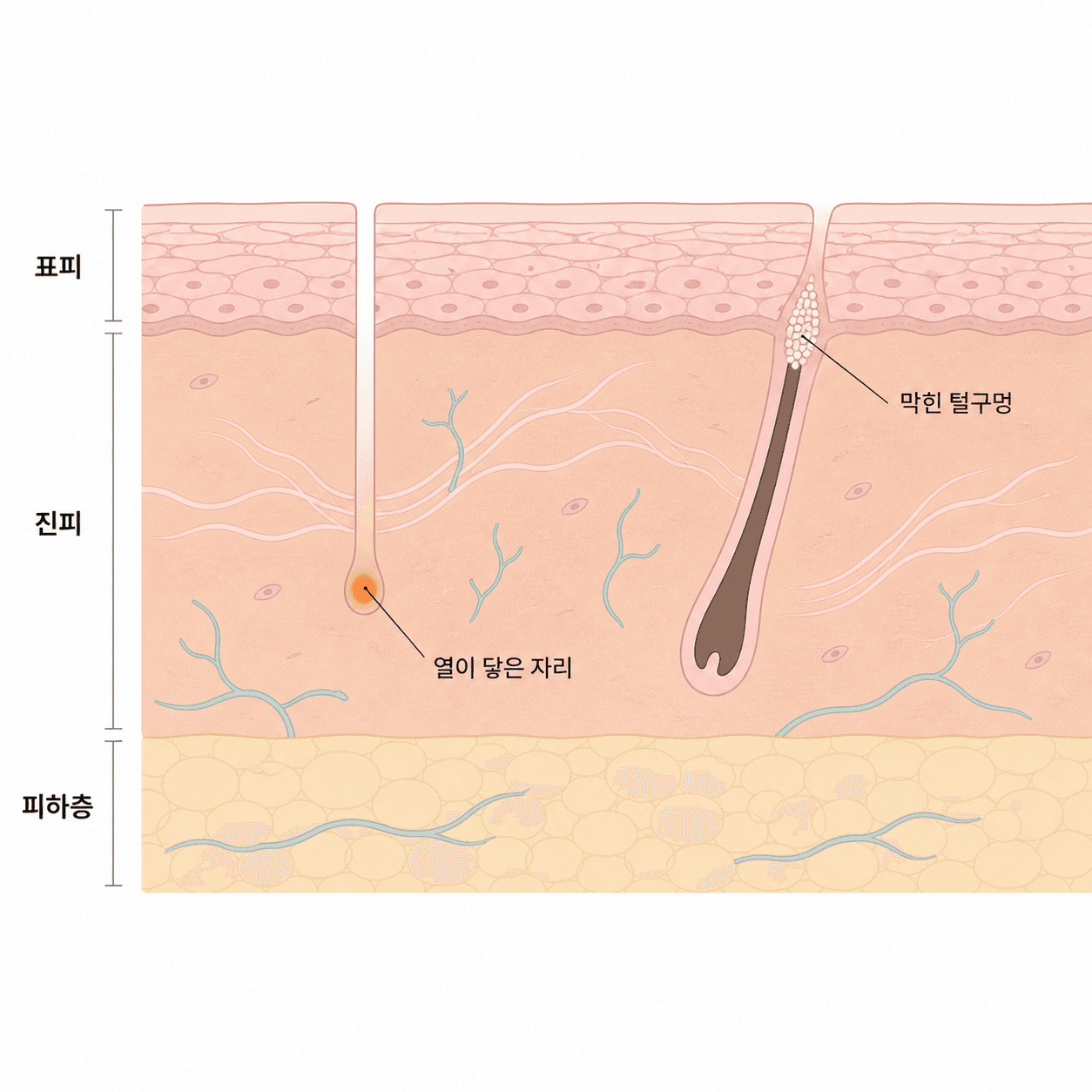 바늘이 낸 통로와 털구멍은 서로 다른 자리예요.