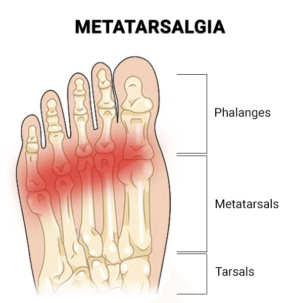 Illustration of Metatarsalgia Treatment