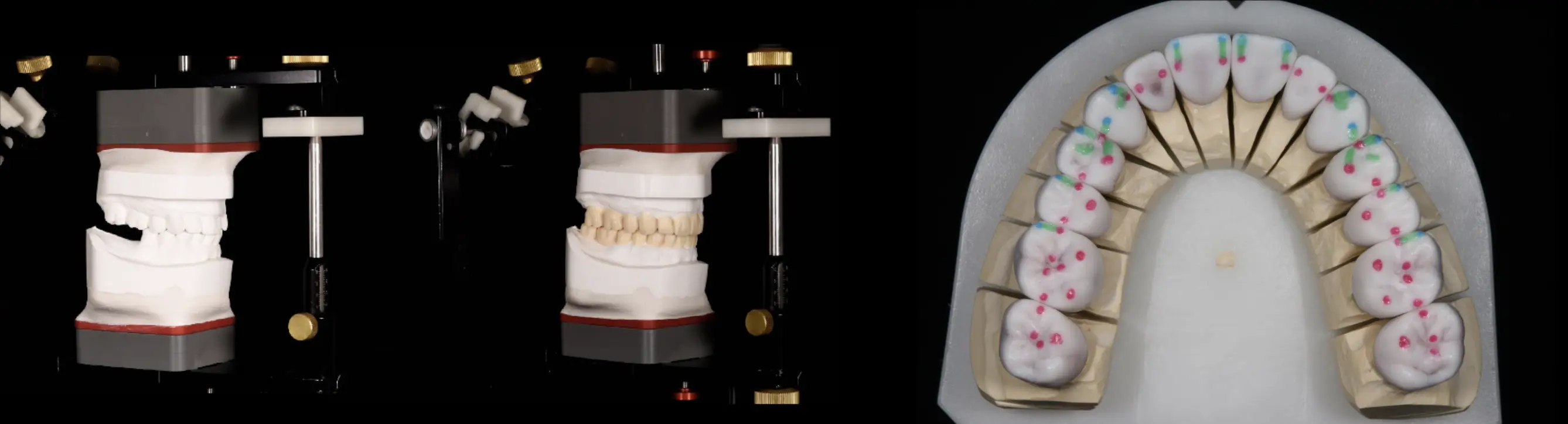 Functional wax-up (wax project for the future rehabilitation)