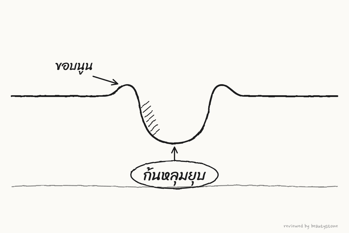 ภาพวาดปากกาแสดงหน้าตัดของแผลเป็นที่ก้นหลุมยุบลง