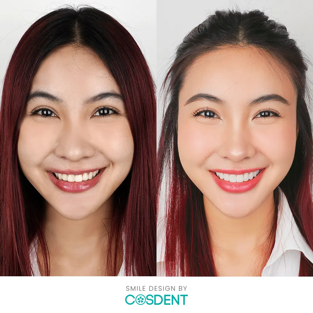 ทำวีเนียร์ที่ Cosdent ดียังไง_ cosdent smile design