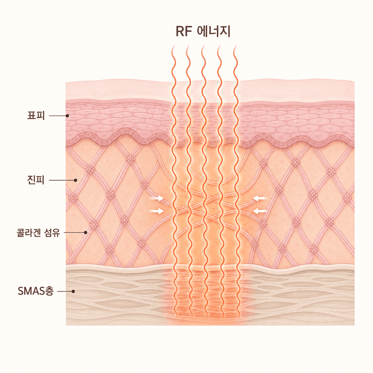 RF 에너지가 진피와 SMAS층에 도달해 콜라겐 섬유를 자극하는 단면