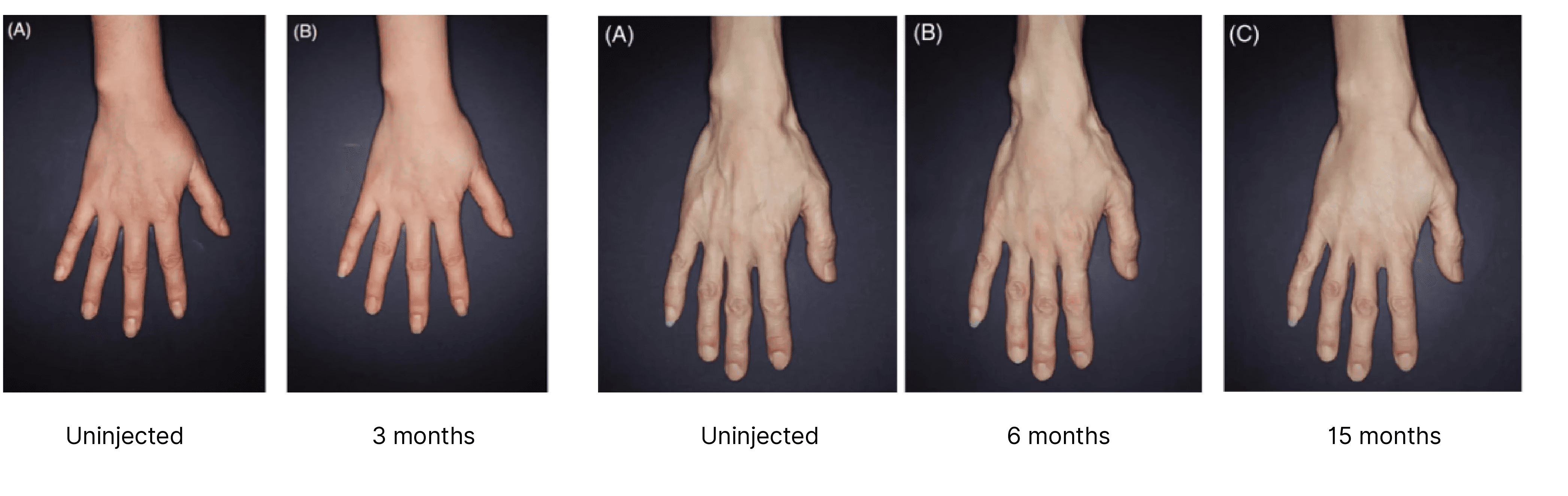 Changes in Handback Treatment Uninjected and Injected