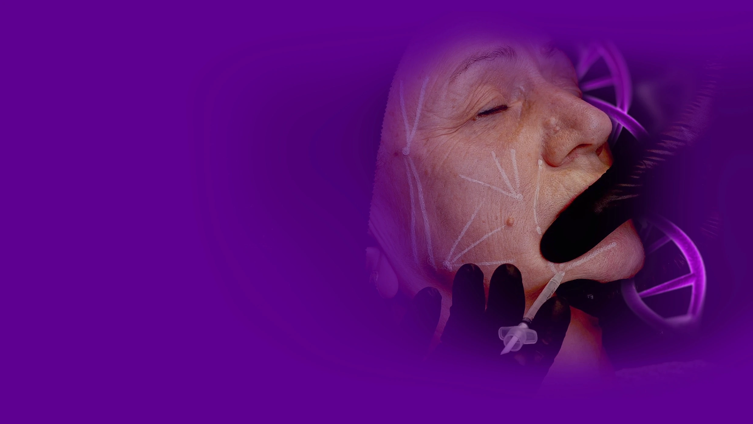 Close-up dramático de um procedimento estético de harmonização facial onde um profissional com luvas pretas aplica uma injeção de preenchedor dérmico na região da bochecha de uma paciente com olhos fechados. Fundo preto focal.