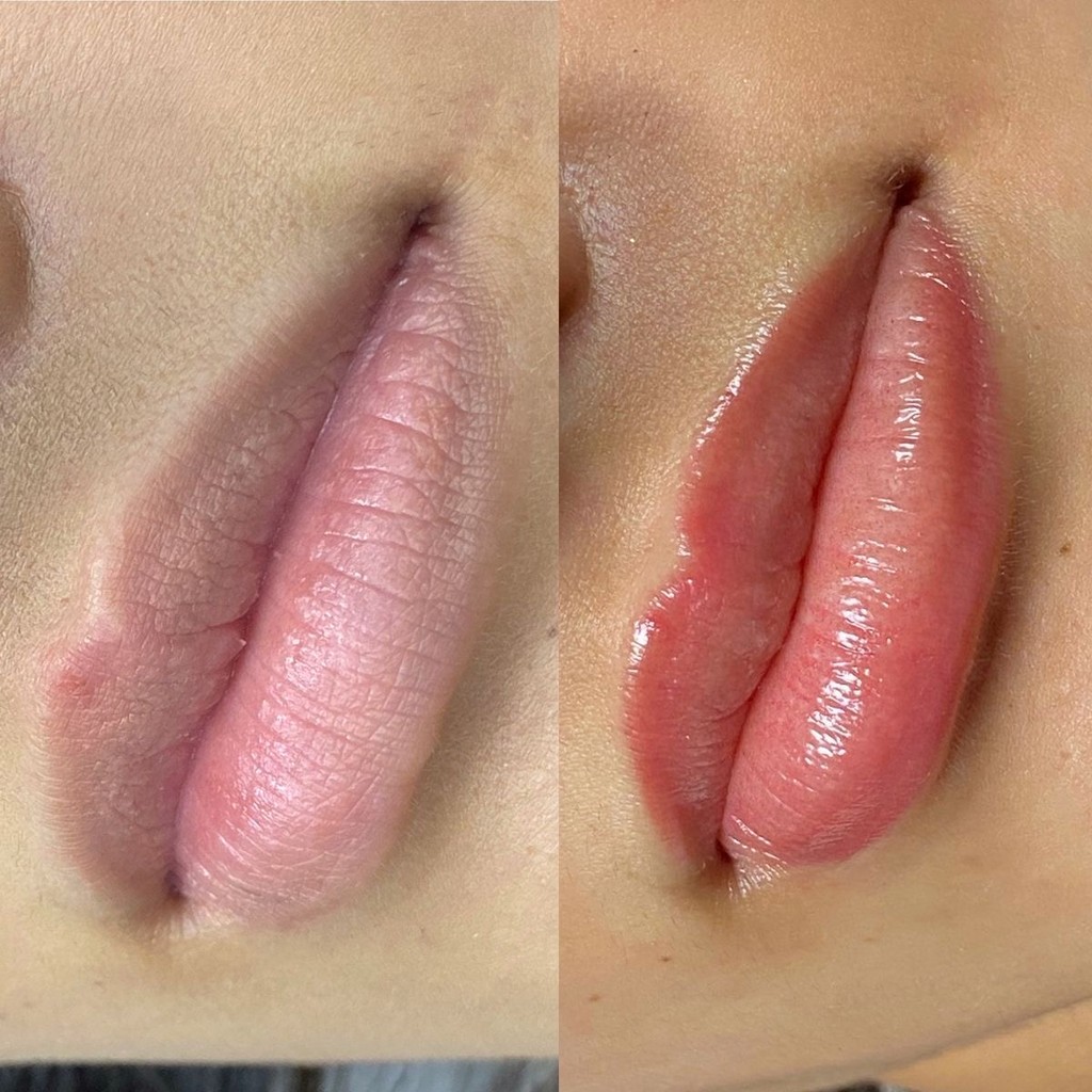 Crop view of lips, before and after the procedure