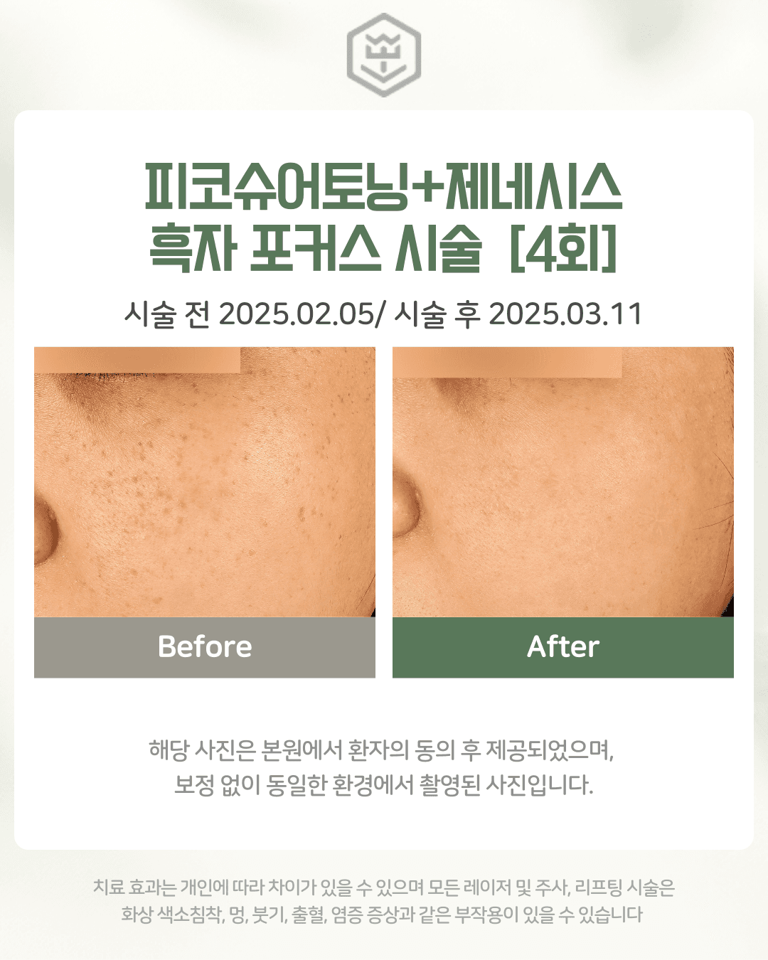 피코슈어+제네시스+흑자포커스 4회