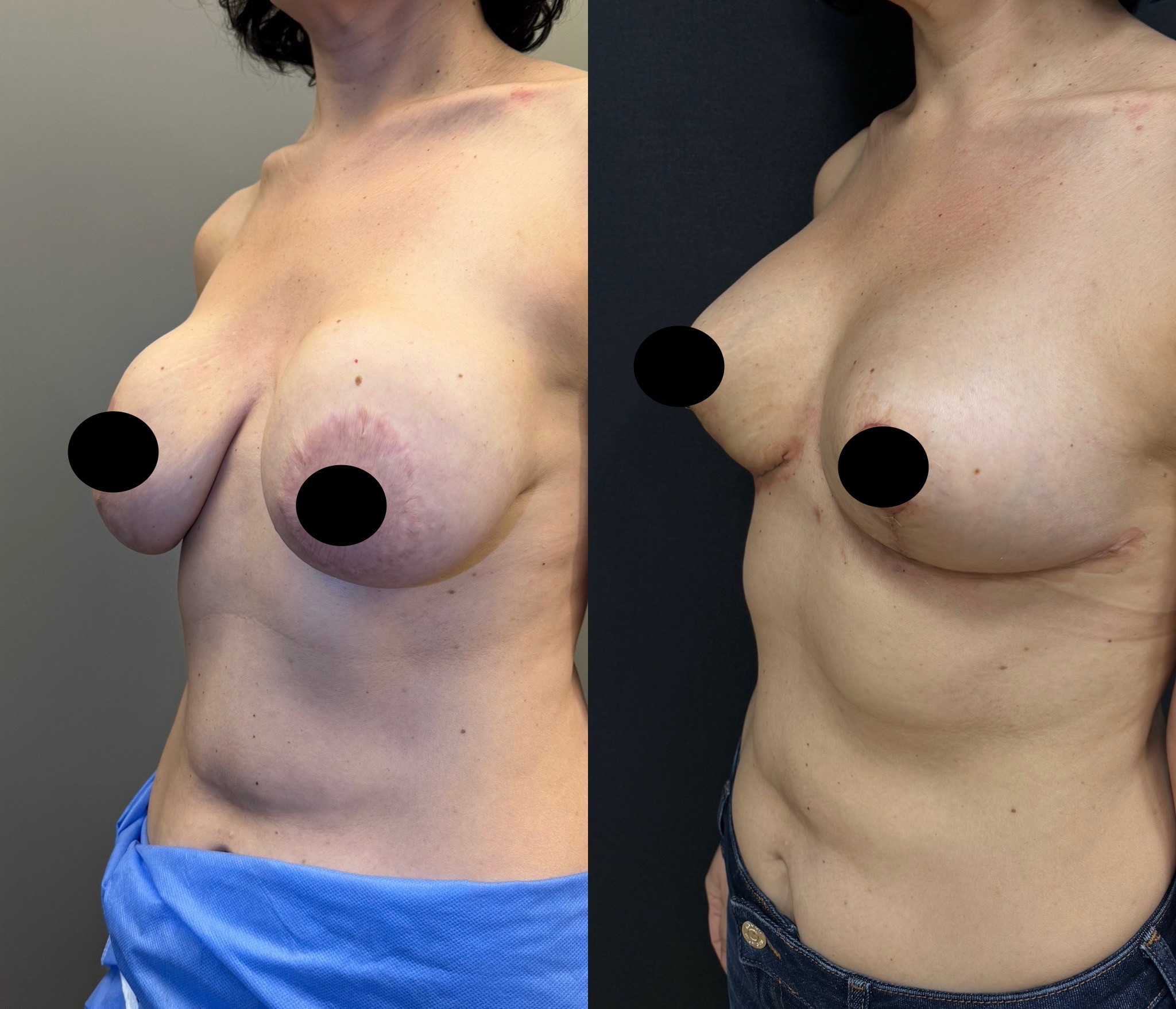 waterfall deformity correction before after breast lift with implant revision left oblique view