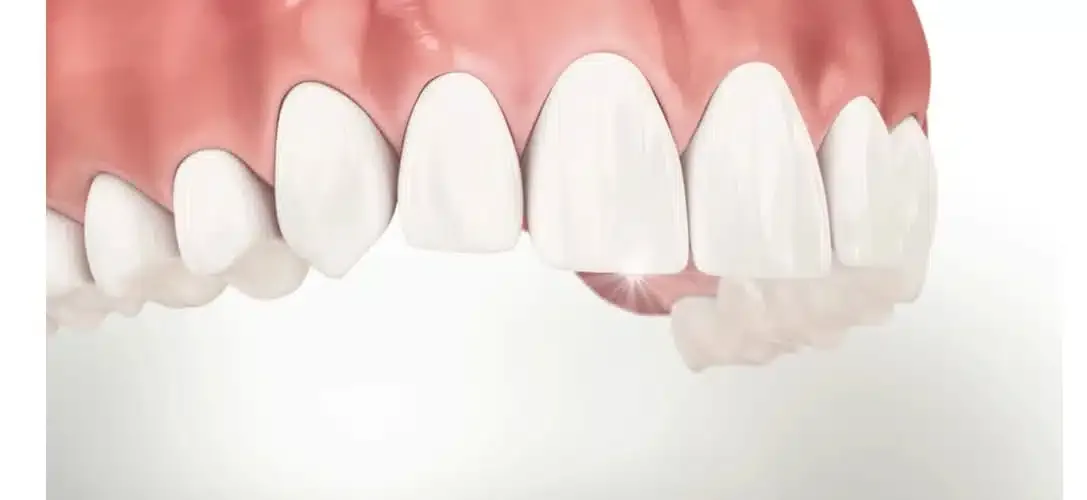 Patient holding a clear aligner tray showing aligned smile at COSDENT Smile Design
