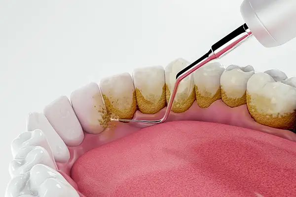 Gum disease causes