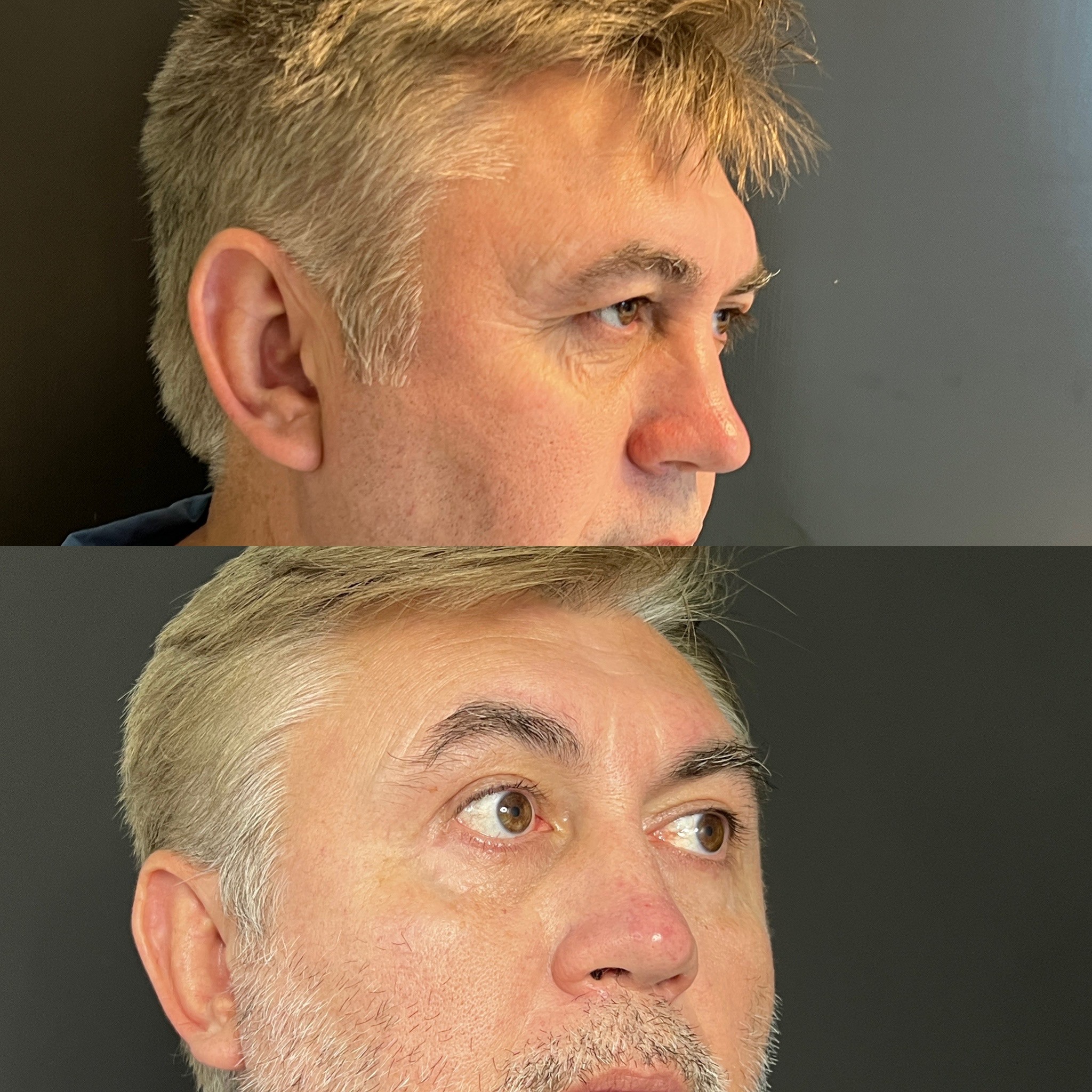 upper and lower blepharoplasty before after 1 month post-op right oblique view