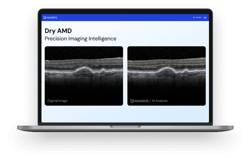 Laptop screen displaying retinal OCT images comparing an original scan with Amaros AI analysis, highlighting biomarkers for Dry AMD
