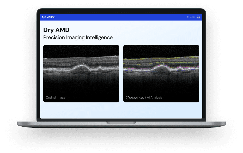 Laptop screen displaying retinal OCT images comparing an original scan with Amaros AI analysis, highlighting biomarkers for Dry AMD