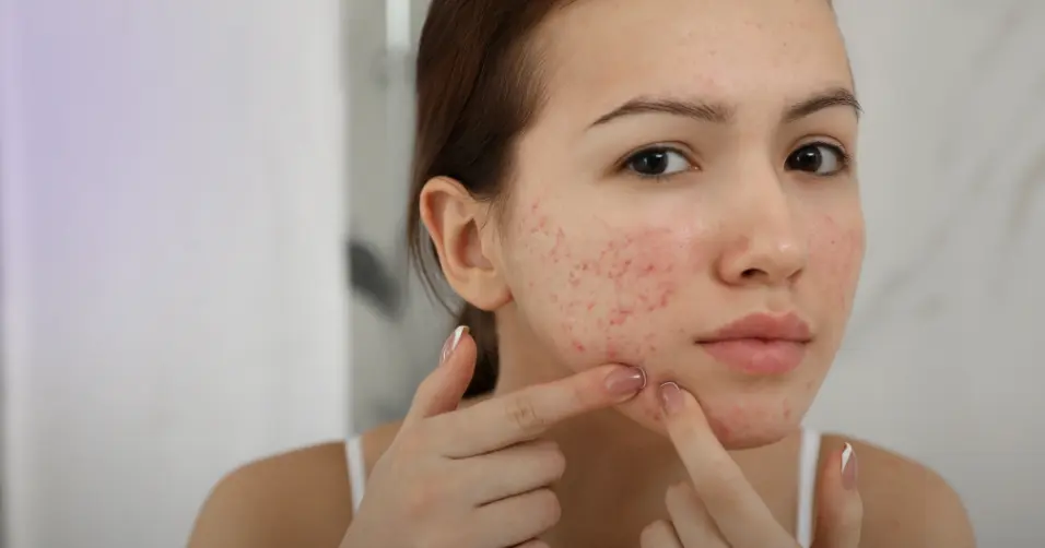 Whey protein may contribute to acne in some individuals.