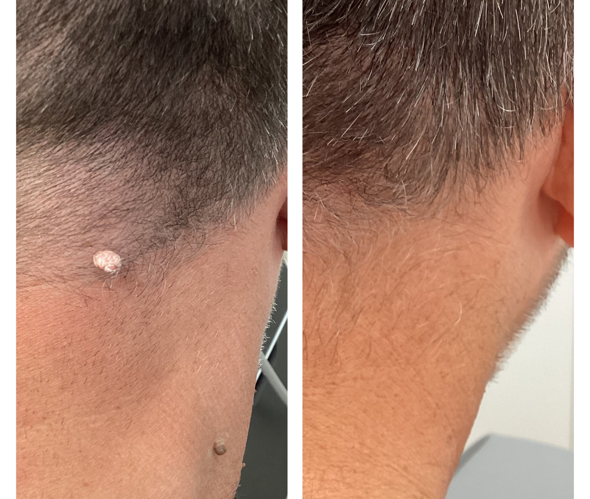 Laser treatment on woman's cheek with protective eye shield