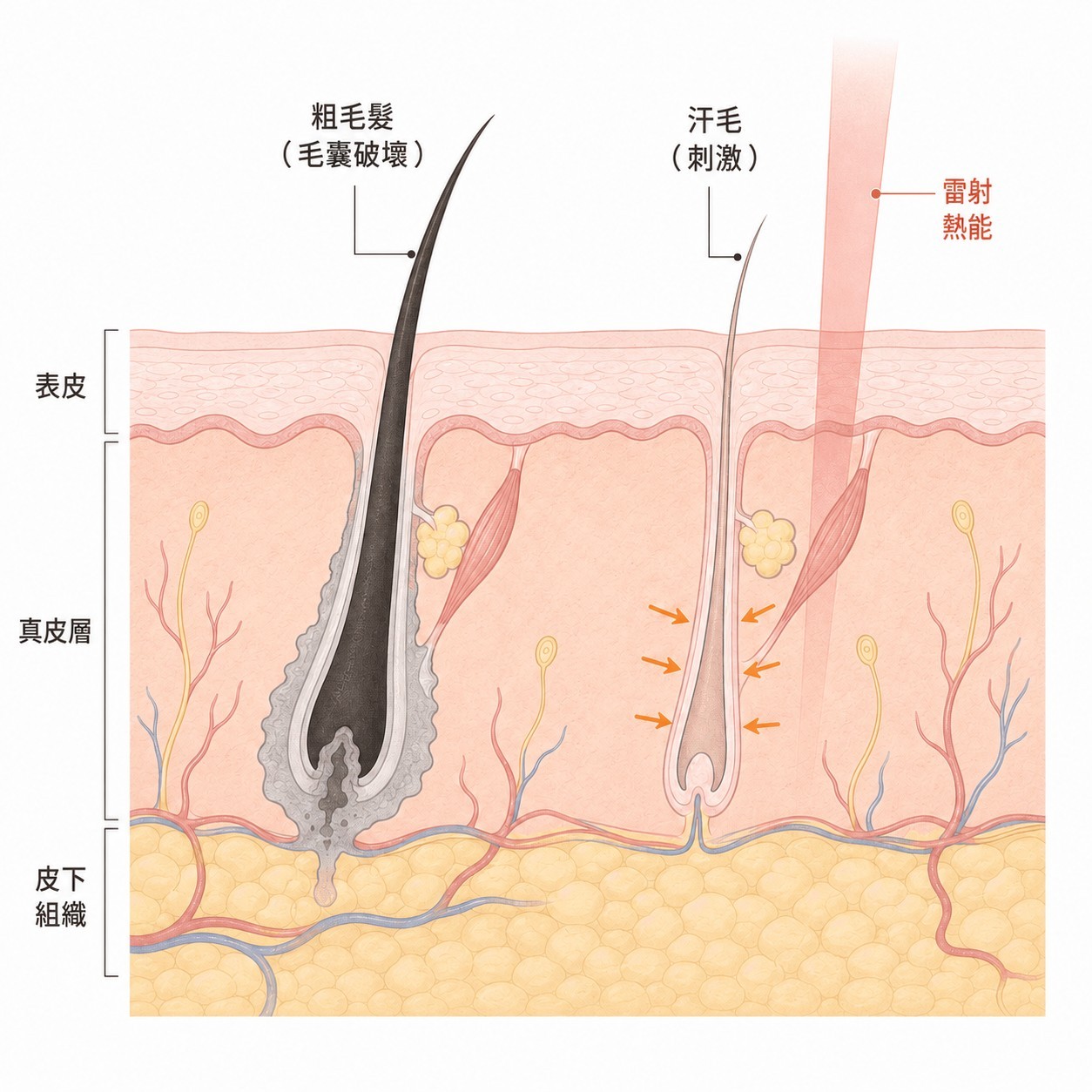 雷射熱能對粗毛囊可能產生破壞作用，對周圍絨毛則可能產生刺激作用