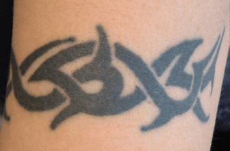 Black tribal-style tattoo on skin before non-laser tattoo removal treatment.