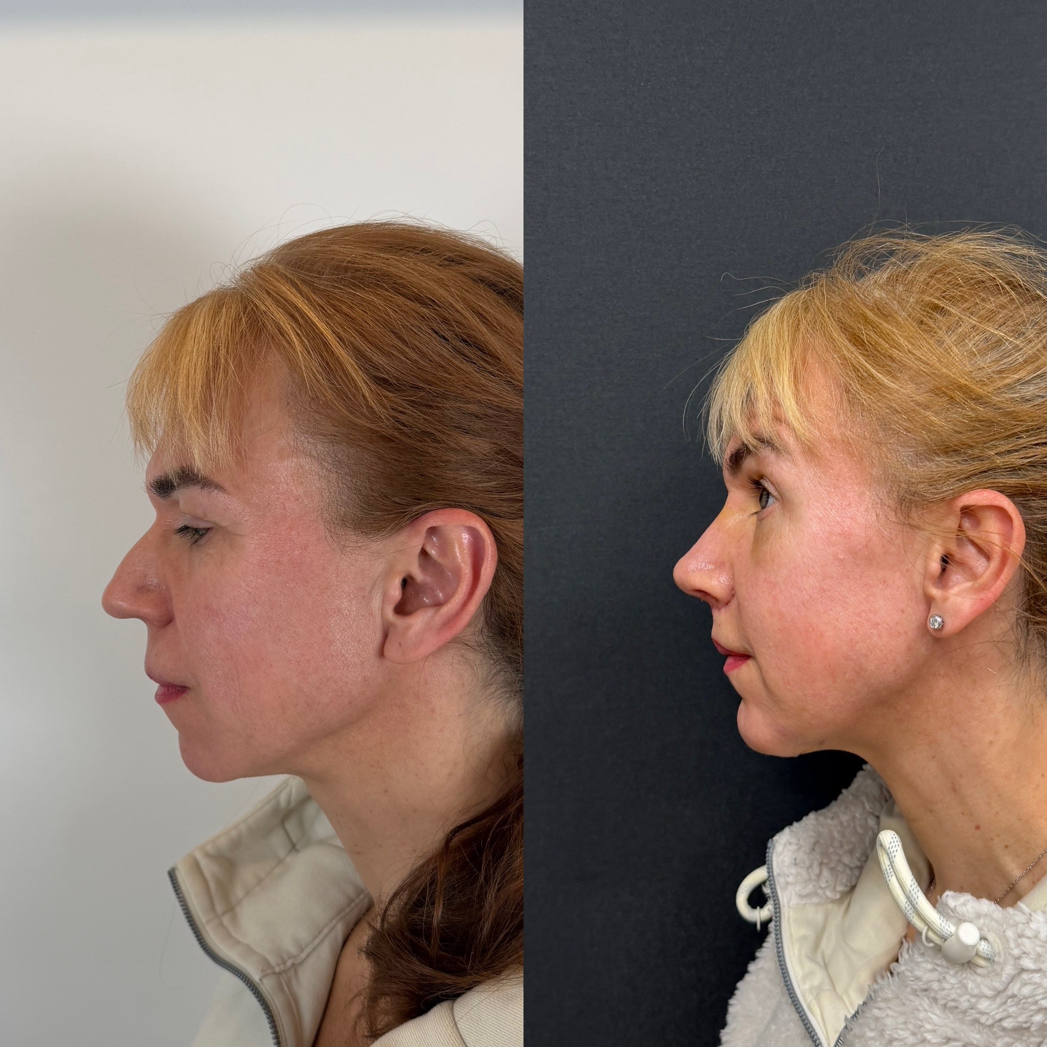 piezo rhinoplasty with chin implant left