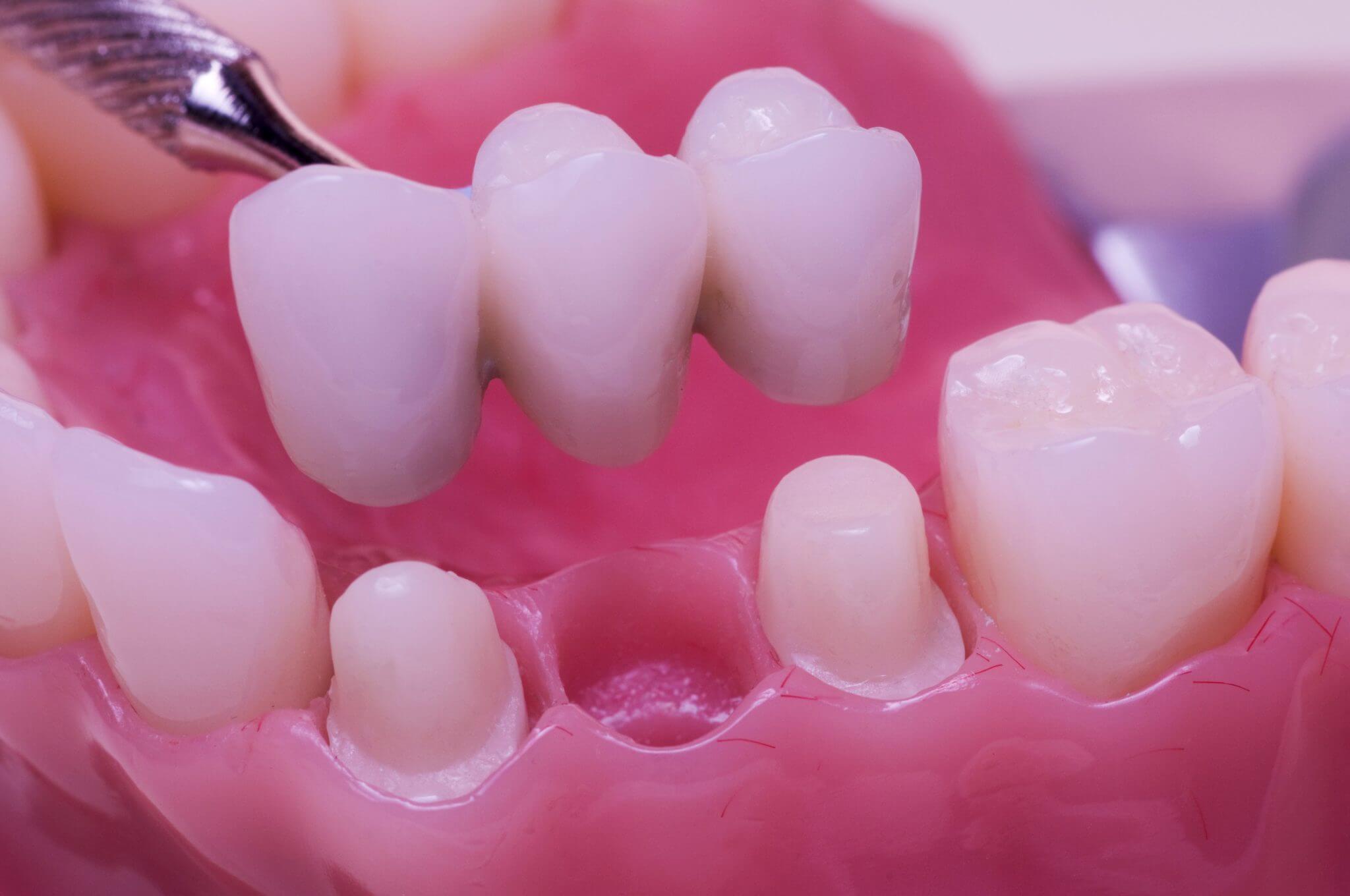 Dental bridges
