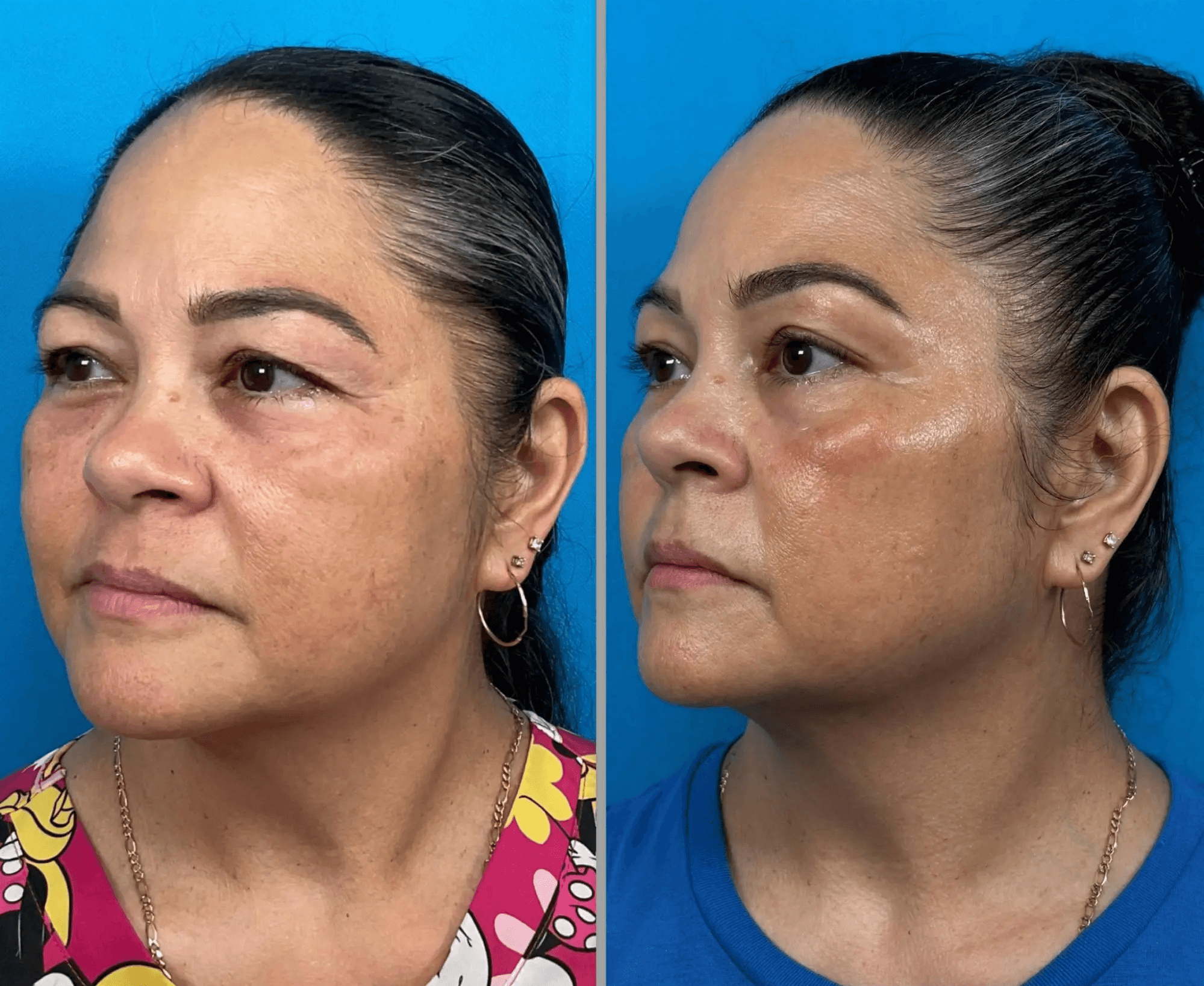Helix CO2 eye rejuvenation before and after treatment results.