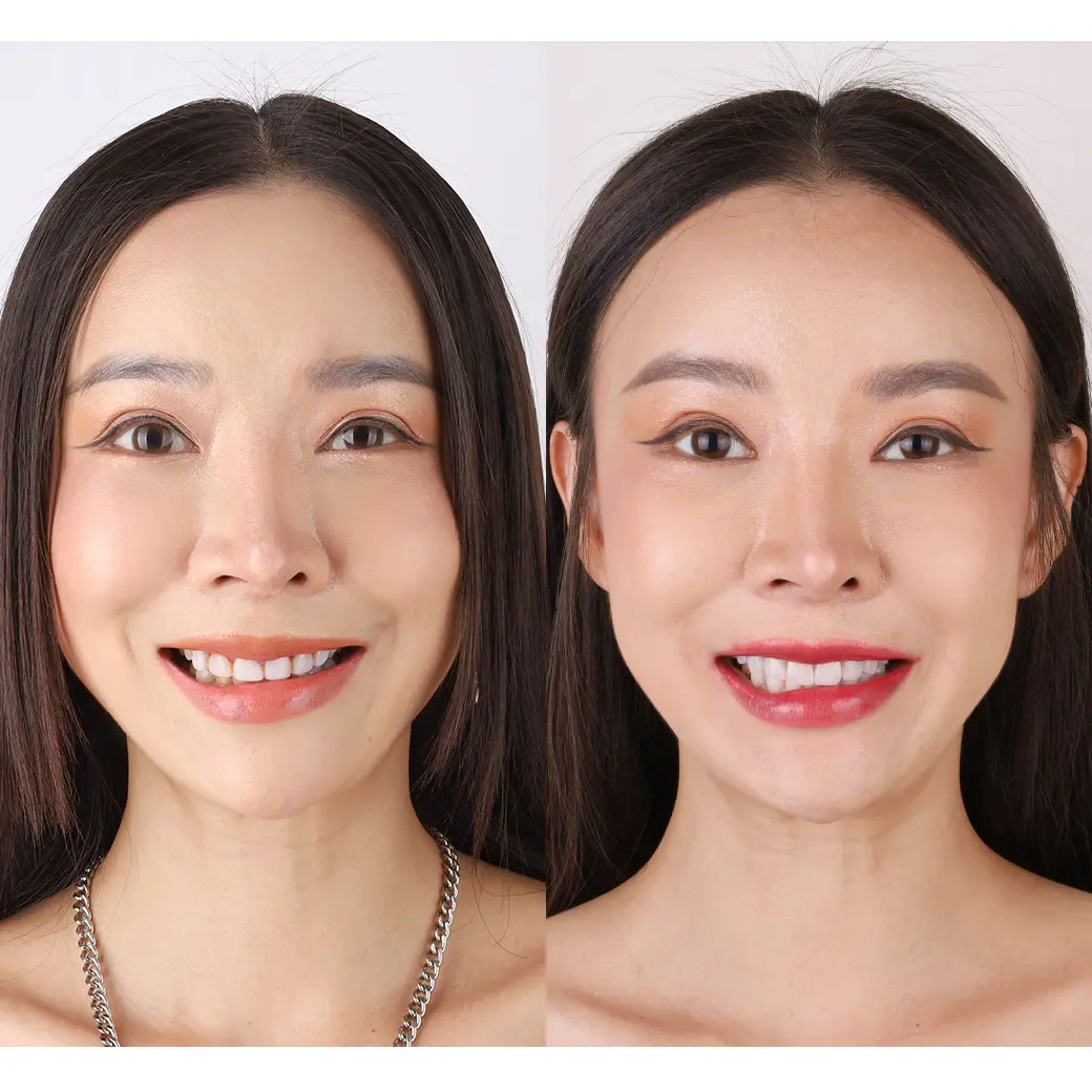 คุณบอลลูน รีวิวเคส หมอแจน cosdent smile design