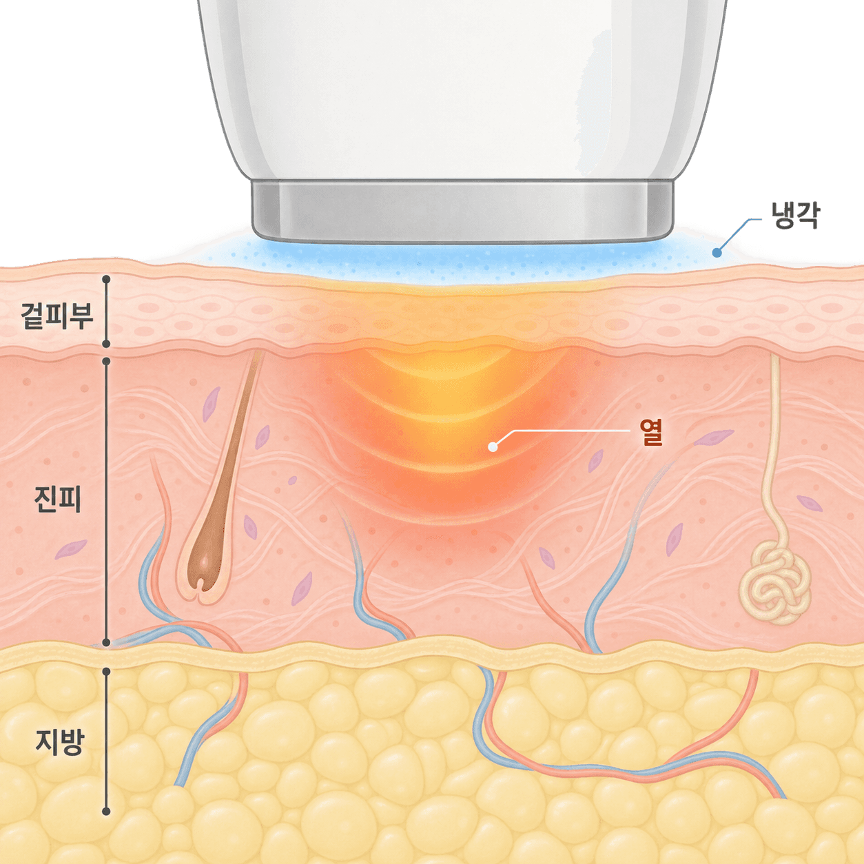 고주파는 진피를 데우고, 냉각은 그동안 겉피부를 식혀요